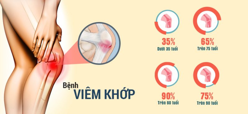 bênh viêm khớp